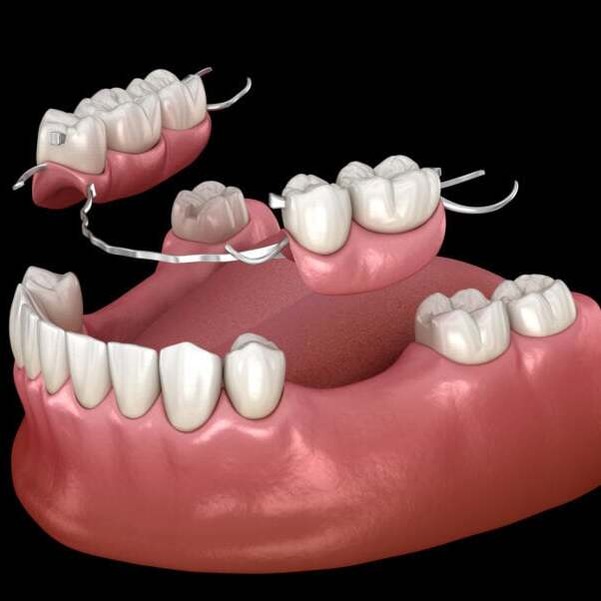 Partial denture treatment image