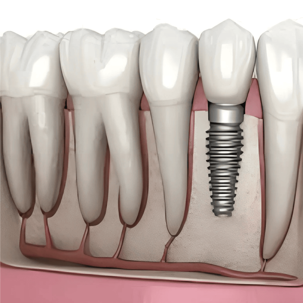 Dental implant treatment illustration