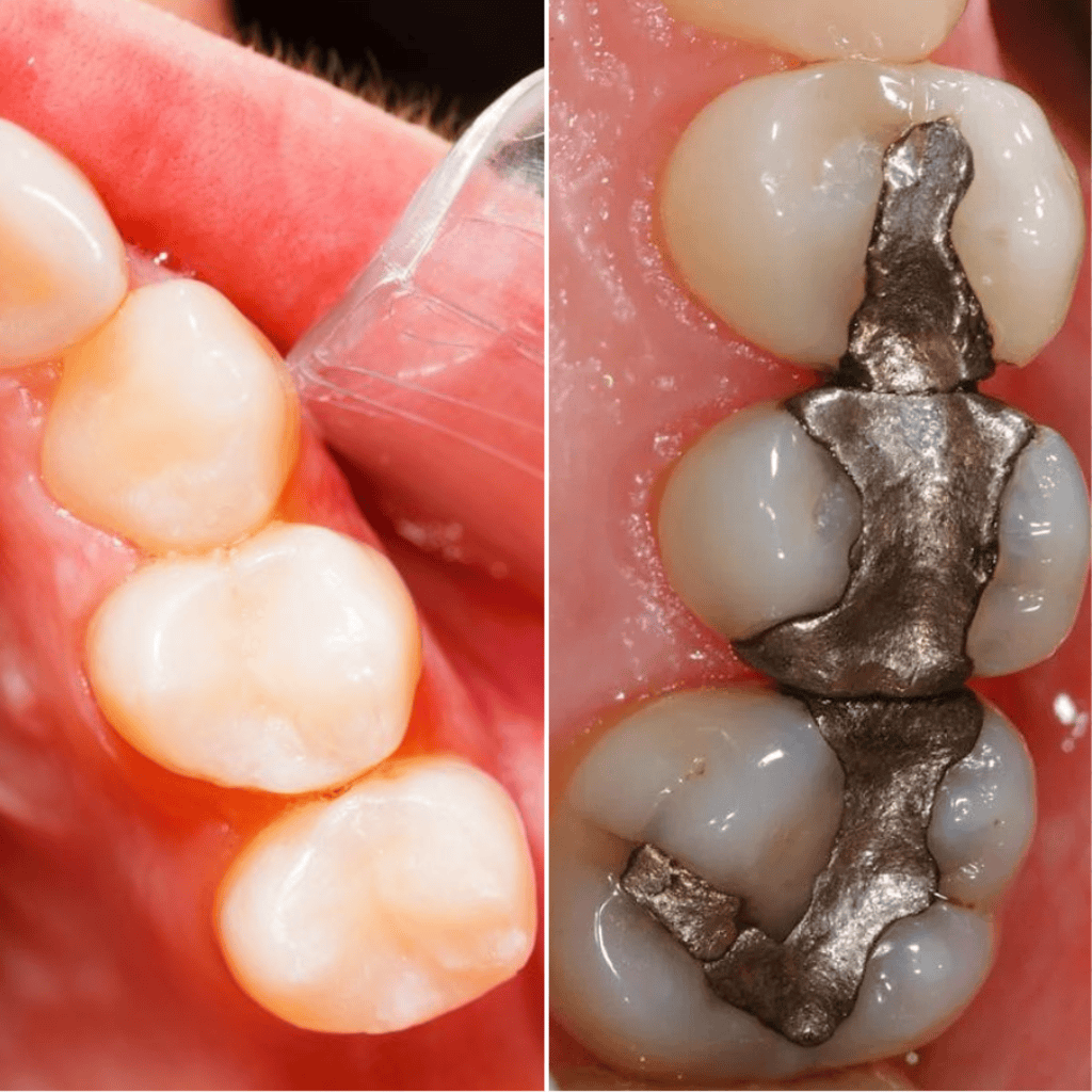 Tooth filling before and after treatment image