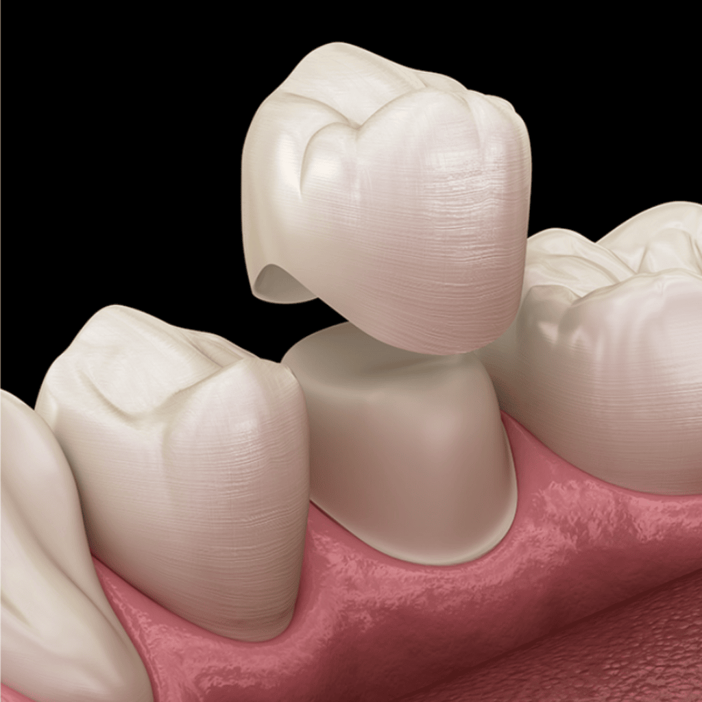 Dental crown restoration image