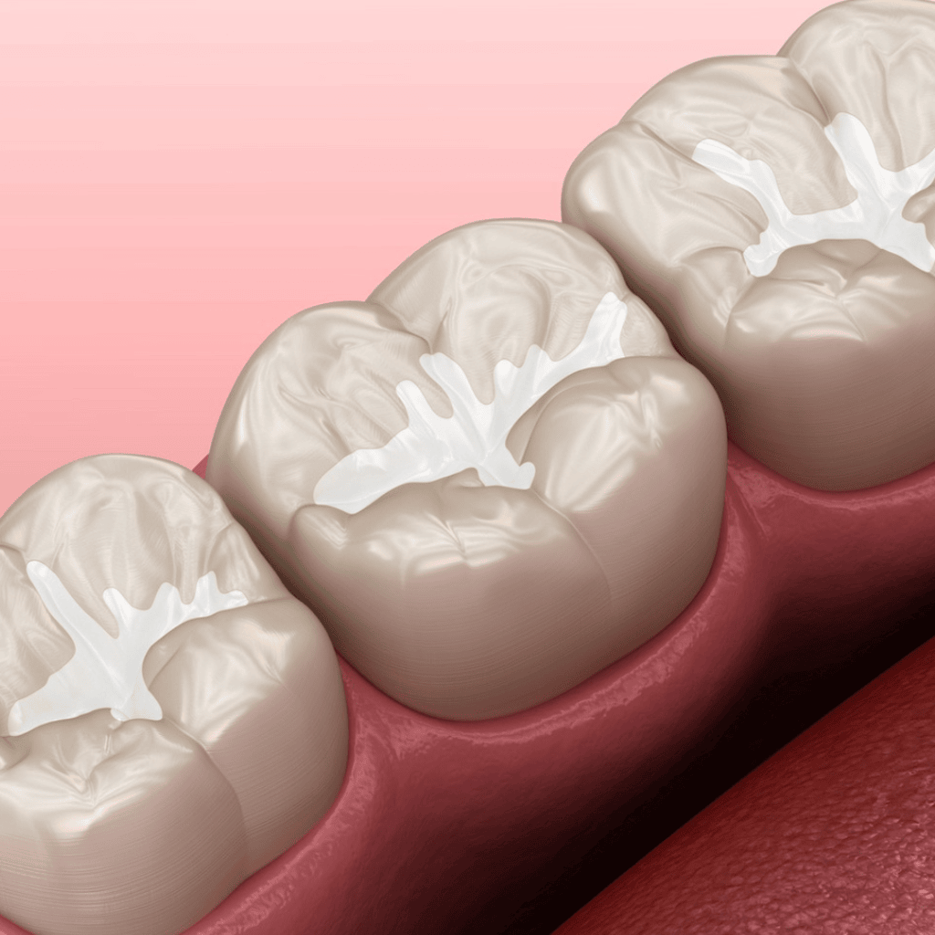 Dental sealant treatment image