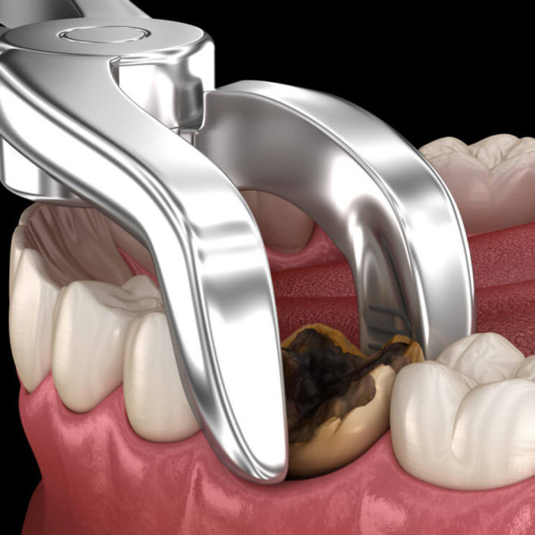 Tooth extraction treatment image