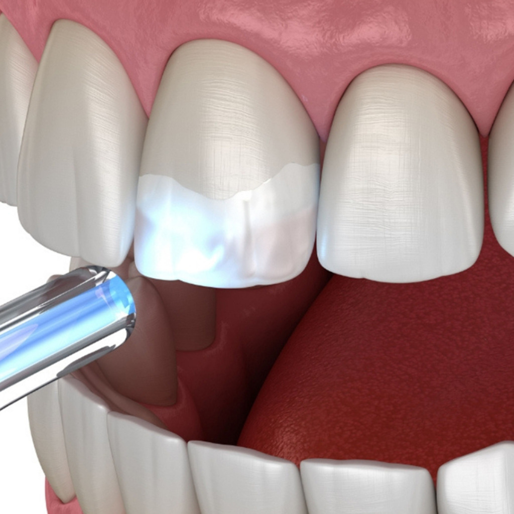 Dental bonding cosmetic treatment image