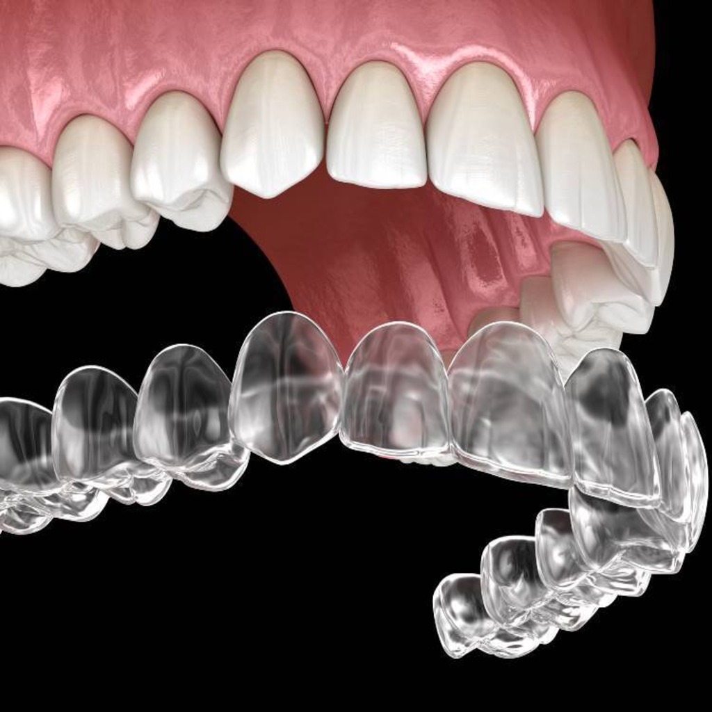 Invisalign clear aligner treatment image