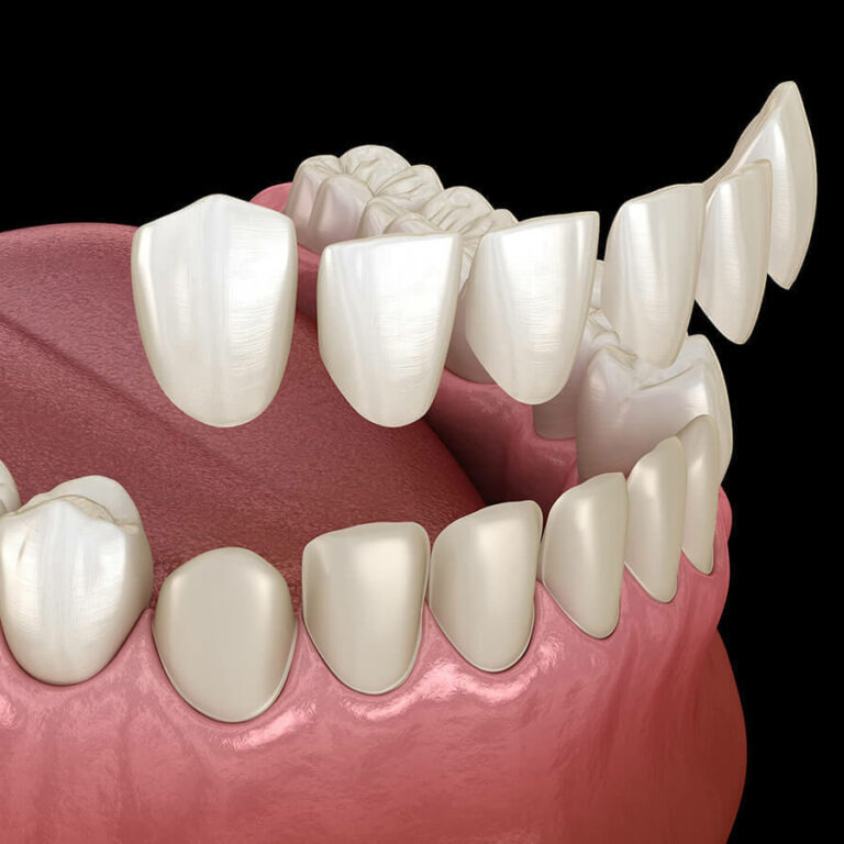 Porcelain veneer cosmetic dentistry image