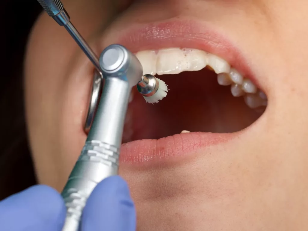 Professional teeth cleaning image
