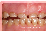 Severe front tooth wear