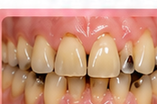 Upper front teeth pushed forward