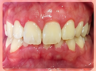 Deep bite wear on front teeth