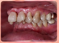 Upper front teeth pushed outward