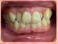 Crossbite and uneven tooth force