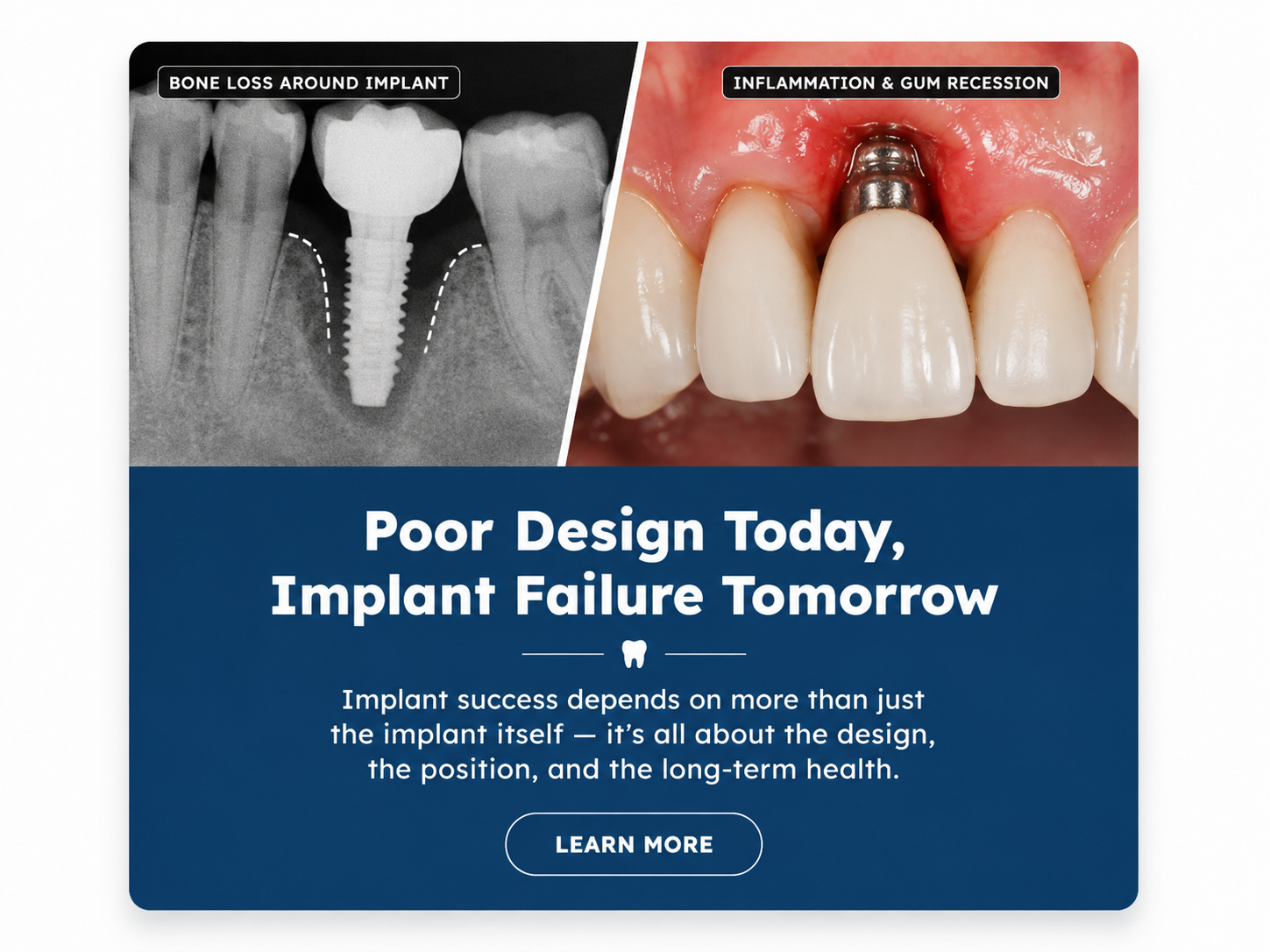 Dental implant complications from poor implant design