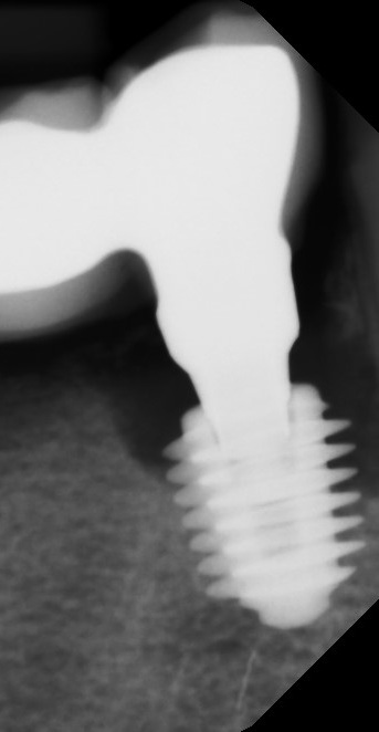 Case X-ray showing significant bone loss around an implant