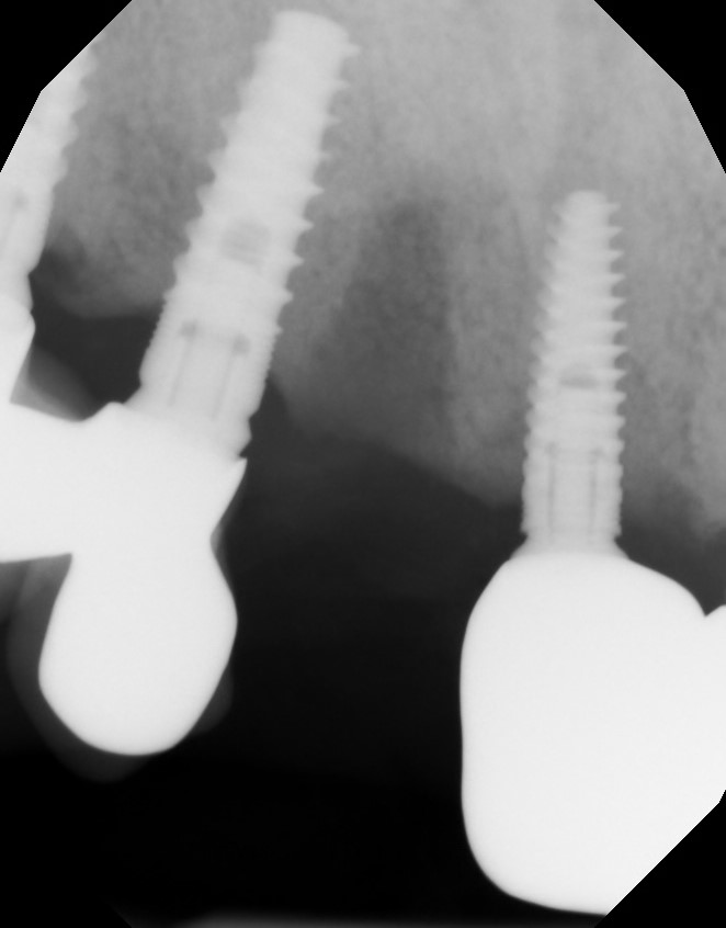 Case image showing subsequent implant loss
