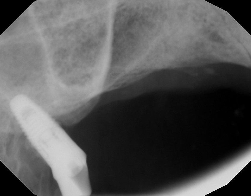 Case X-ray showing an implant that can no longer serve as a restorative foundation