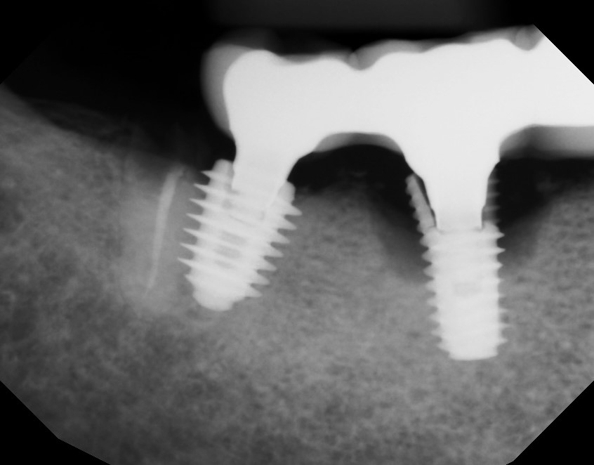 病例 X-ray:种植修复区域发生断裂。
